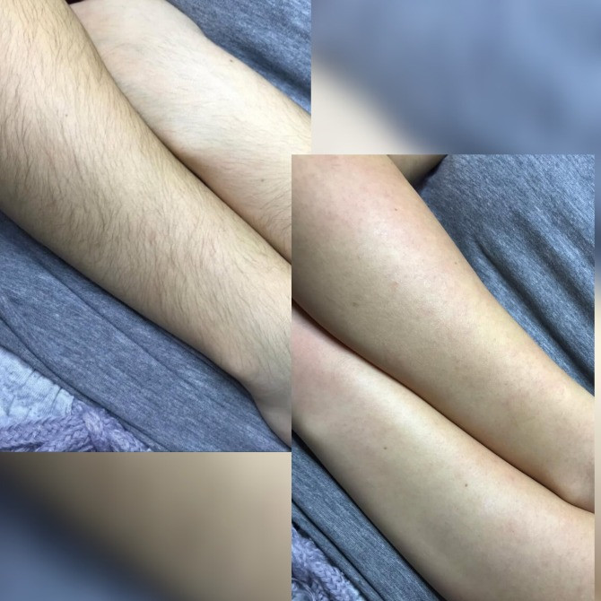 Депіляція віск/шугаринг Луцк - изображение 4